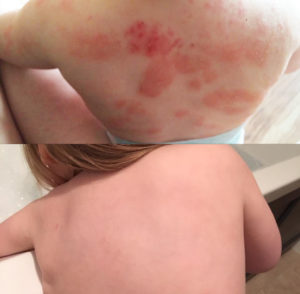 Daisy skin rash before and after images