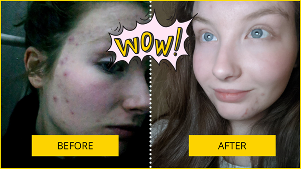 Before and After Acne Results